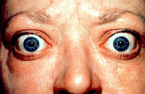 Thyroid eye disease before and after
