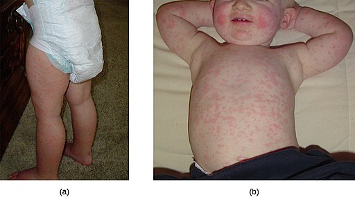 Photo of child with Roseola