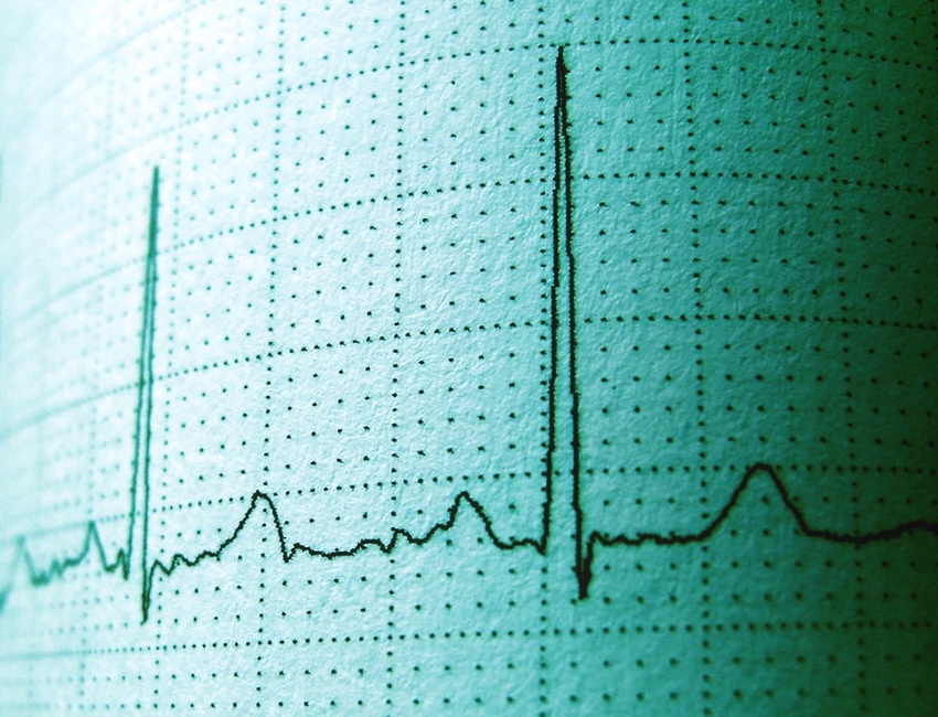 ECG showing heart rate variability