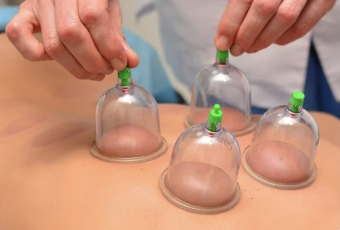 Cupping: Ancient Therapy with Modern Benefits