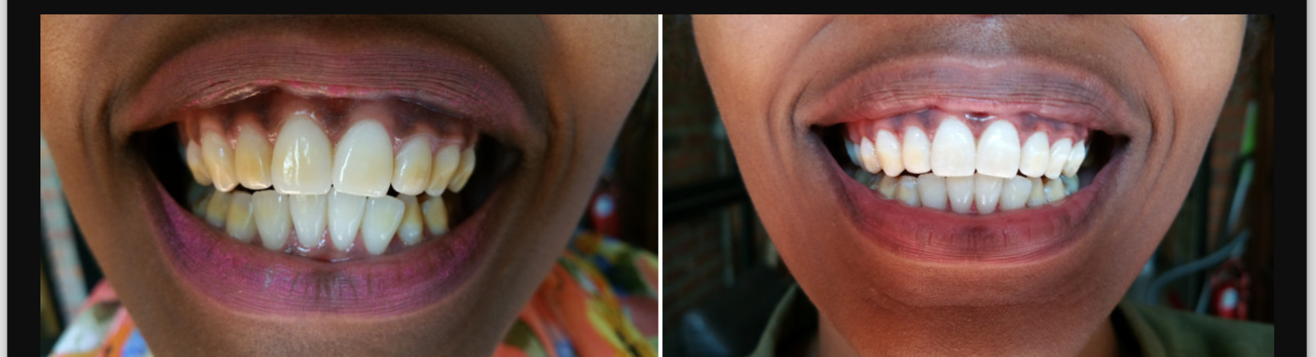 More on Teeth Whitening