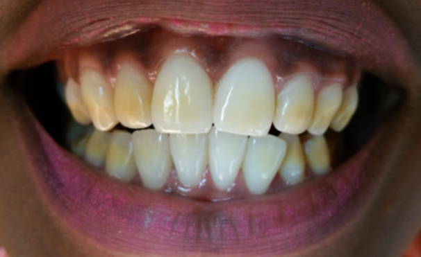 Teeth whitening part 2