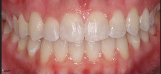 Teeth whitening Series