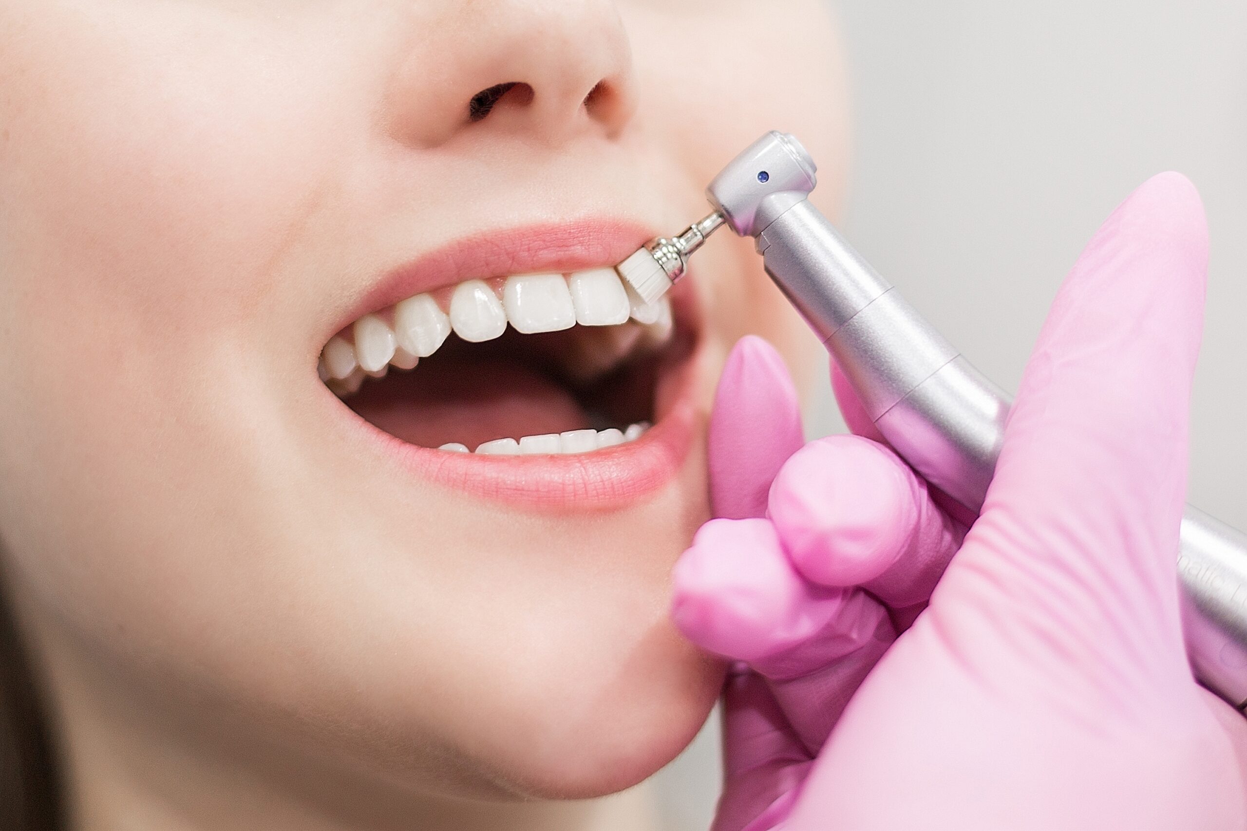 How to Do Dental Scaling and Polishing