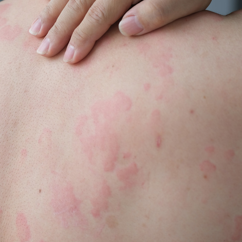 Your pediatric ALL patient has an E.coli asparaginase allergy—now what ...