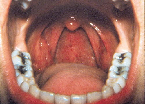 papilloma cancer throat)