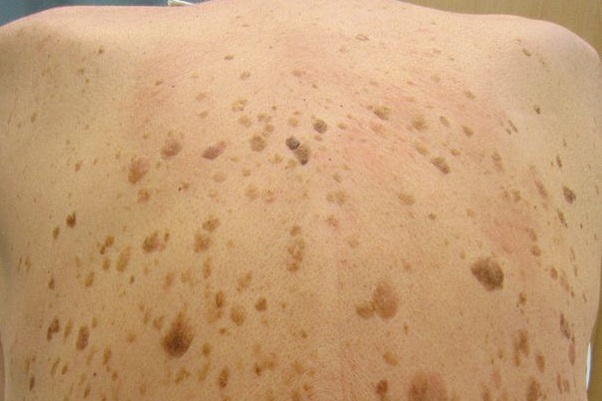 Can You Pick Off Seborrheic Keratosis Skin Tumor Study Leads To Topical Treatment For Seborrheic Keratosis Mdlinx