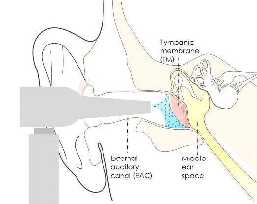 One Shot Spray Could Cure Kids Ear Infections Mdlinx