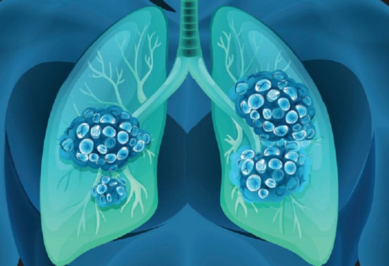 Detect lung cancer sooner and predict prognosis with sputum sample | MDLinx