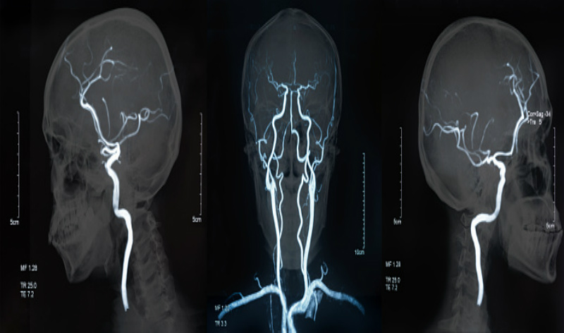 Clopidogrel/aspirin combo reduces risk for ischemic stroke, but ...