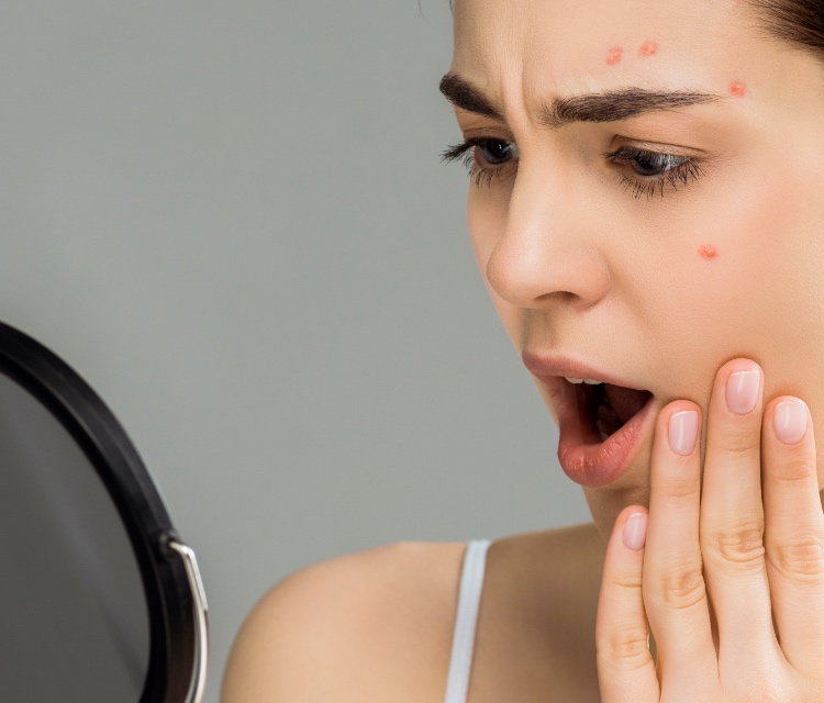 What Causes Acne image