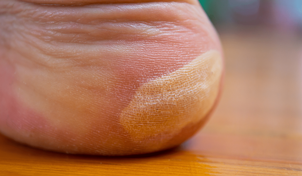 Remedios caseros para eliminar callos y callosidades