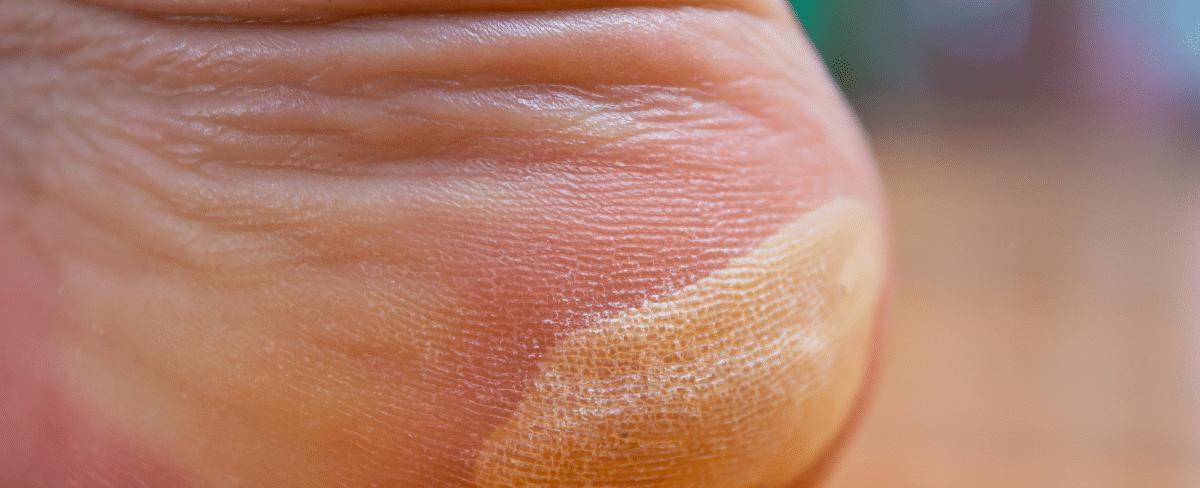 Remedios caseros para eliminar callos y callosidades