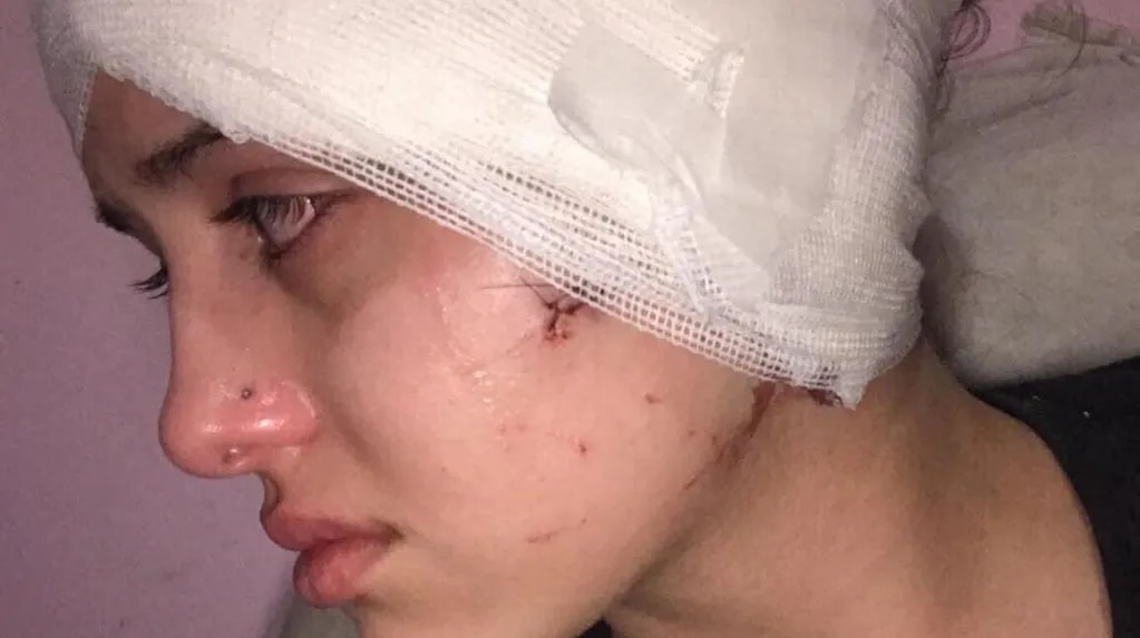 El duro relato de la moza agredida por dos hombres en Mendoza: “La depresión de verme así no me la saca nadie"