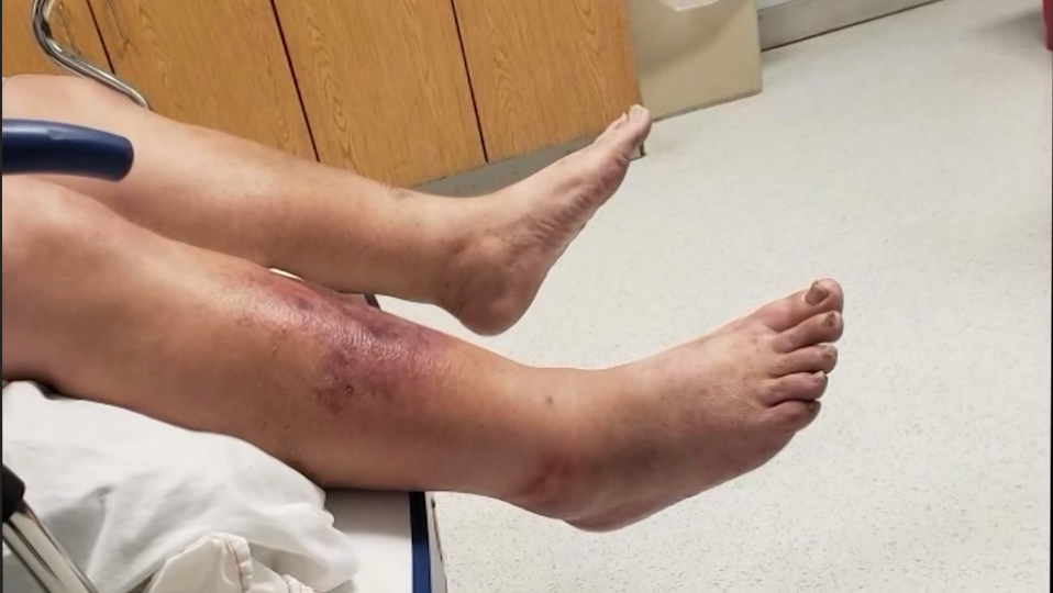 Bacteria ‘come carne’ en expansión en EEUU debido al calentamiento global: síntomas y cómo protegerte