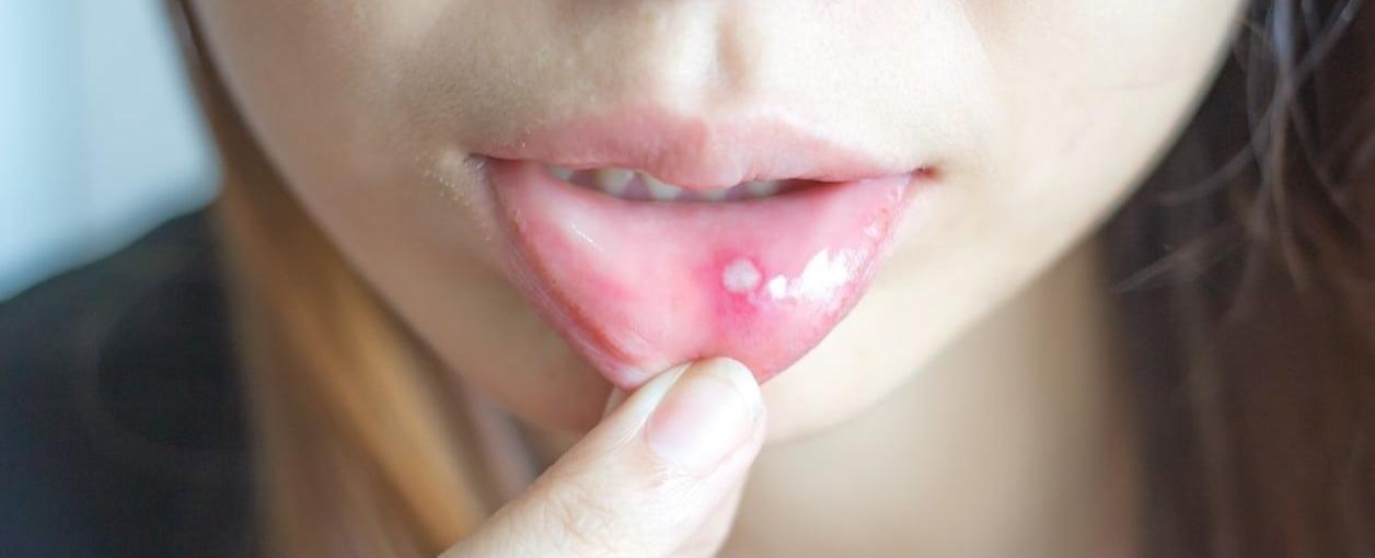 Llagas en la boca: por qué salen y remedios caseros para combatirlas