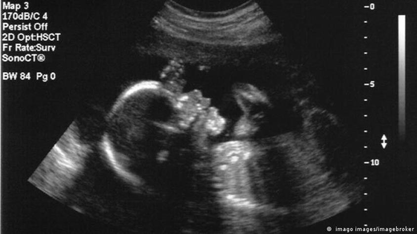 Médicos realizan con éxito primera cirugía cerebral de un feto