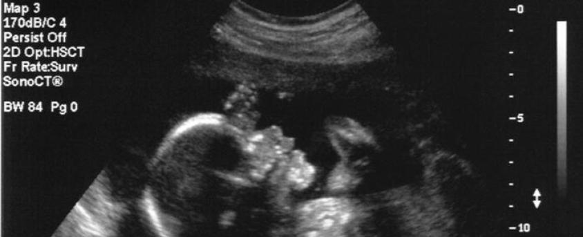 Médicos realizan con éxito primera cirugía cerebral de un feto