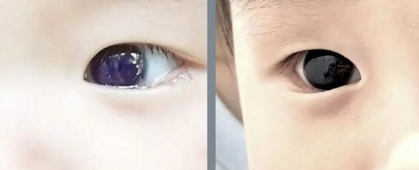 Bebé cambia color de ojos tras tratamiento contra el Covid