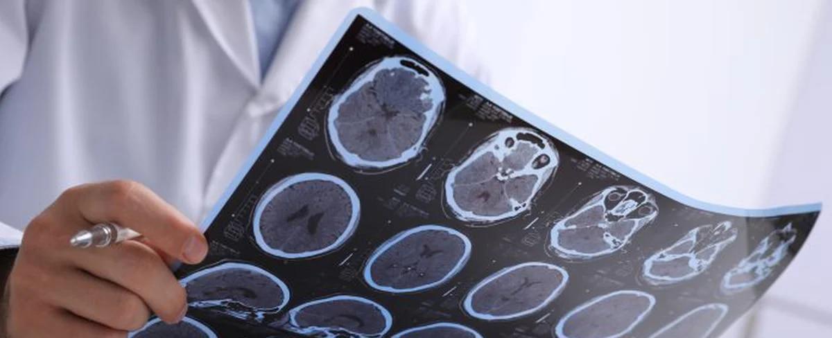 Detectan un sorprendente vínculo entre el ayuno intermitente y la enfermedad de Alzheimer