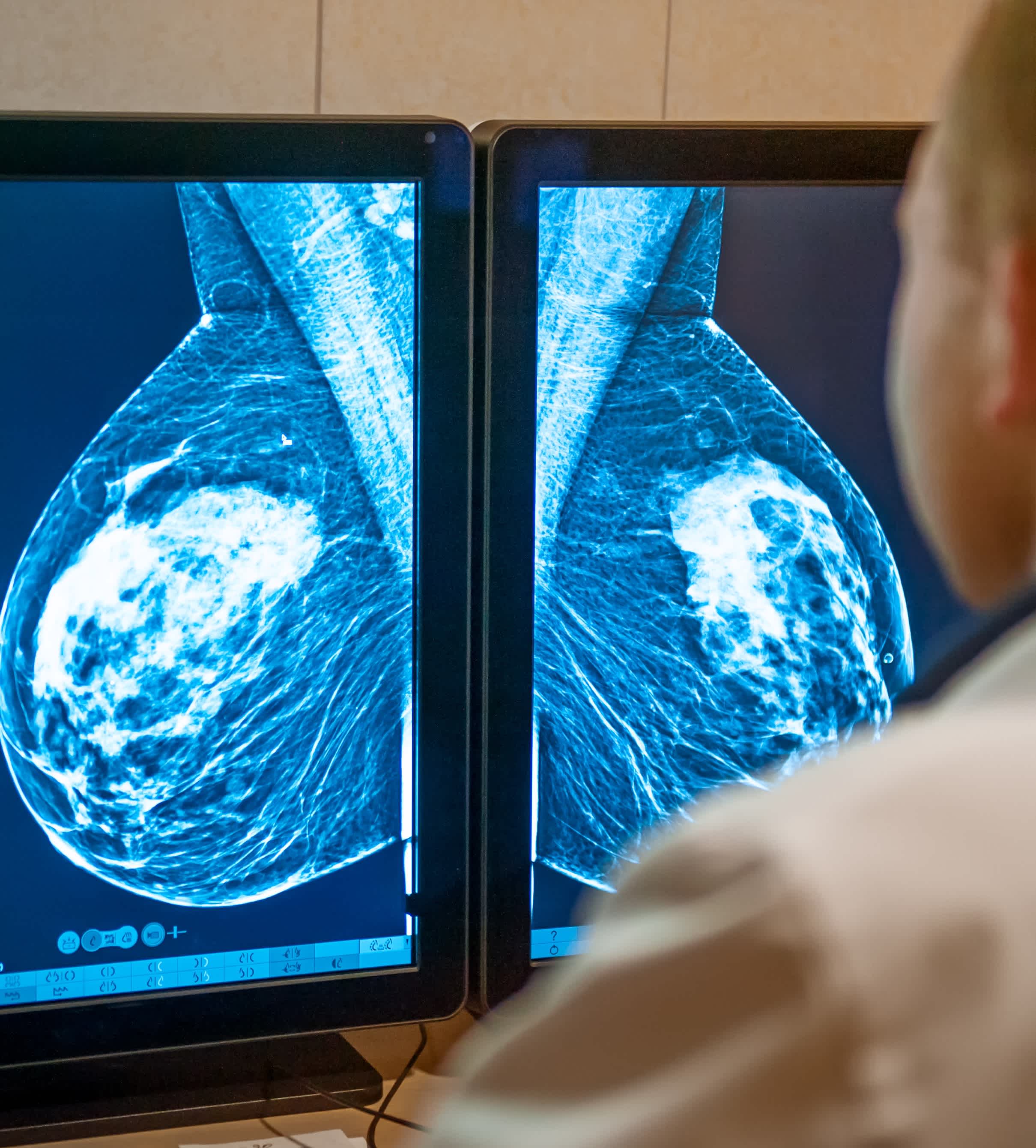 Clinician reviewing mammogram images on dual monitors