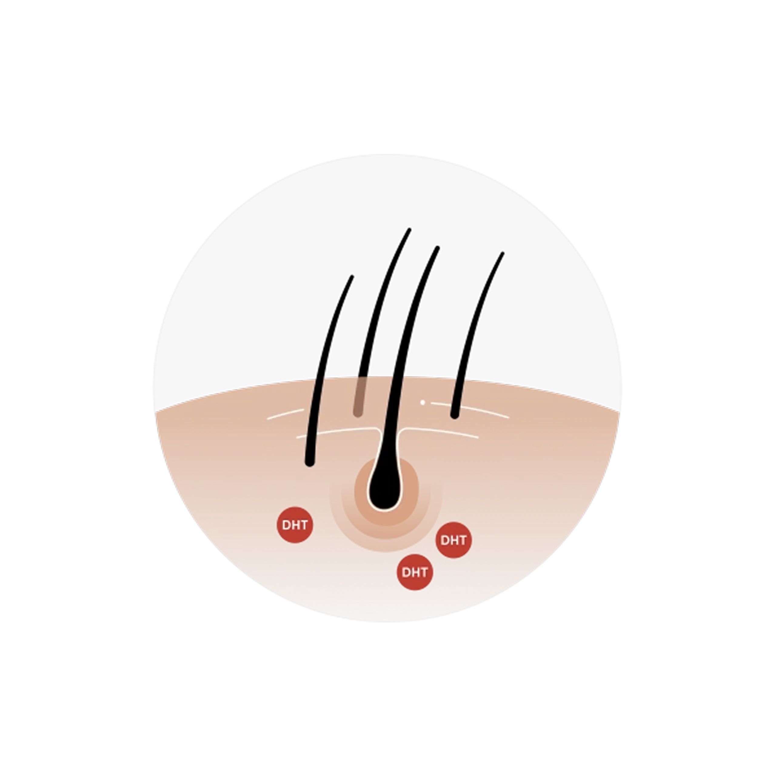 DHT attacking hair follicles and shrinking them
