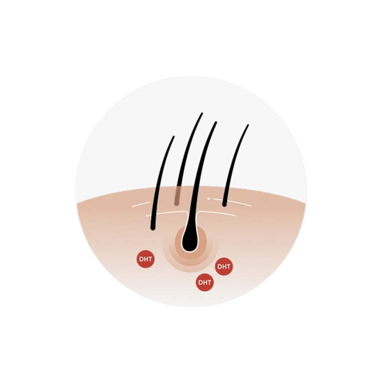 DHT attacking hair follicles and shrinking them
