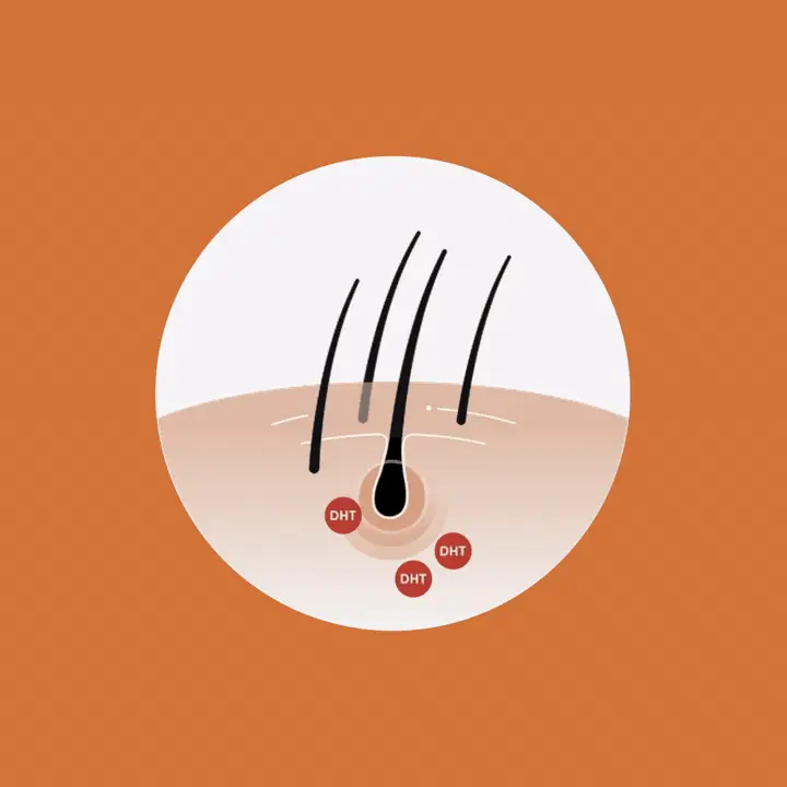 DHT attacking hair follicles and shrinking them