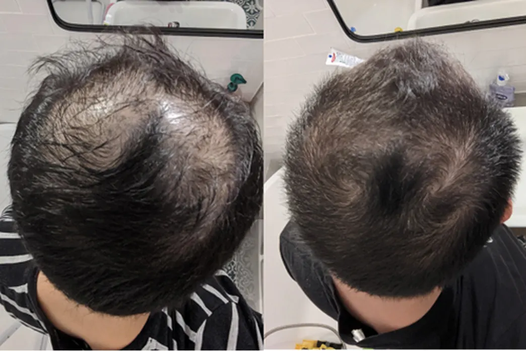 Before and after image of a man using hair loss treatment program by Hims