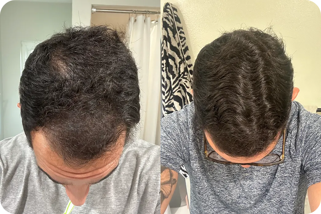Before and after image of a man using Hims hair loss treatment plan