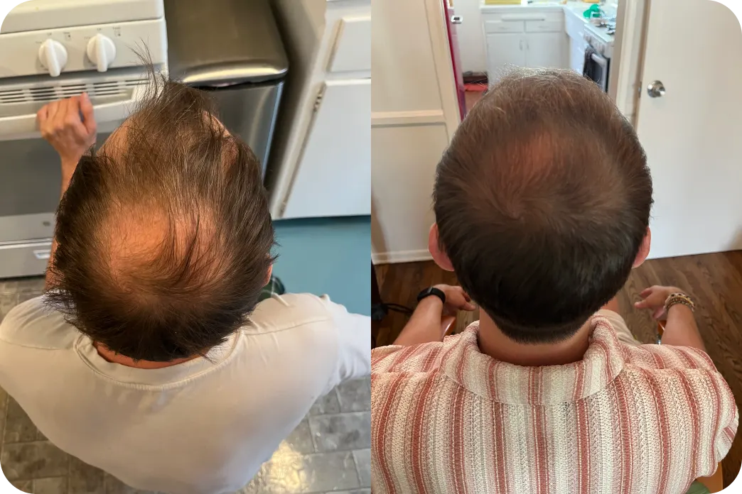 Before and after image of a man using Hims hair loss treatment plan