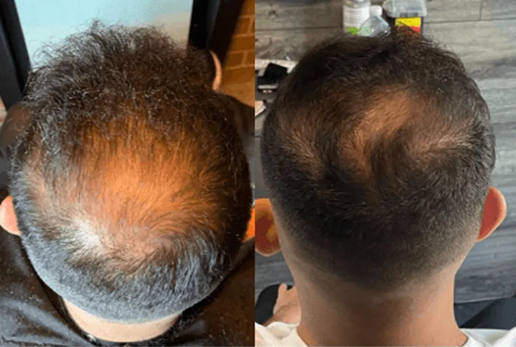 Before and after image of a man using hair loss treatment program by Hims