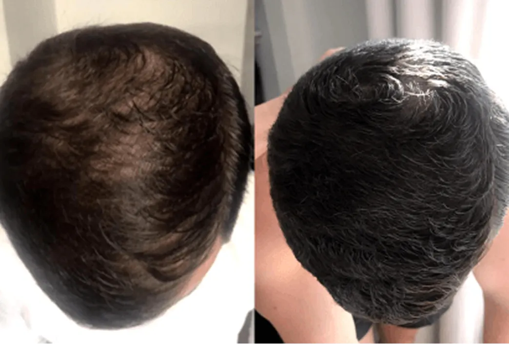 Before and after image of a man using hair loss treatment program by Hims