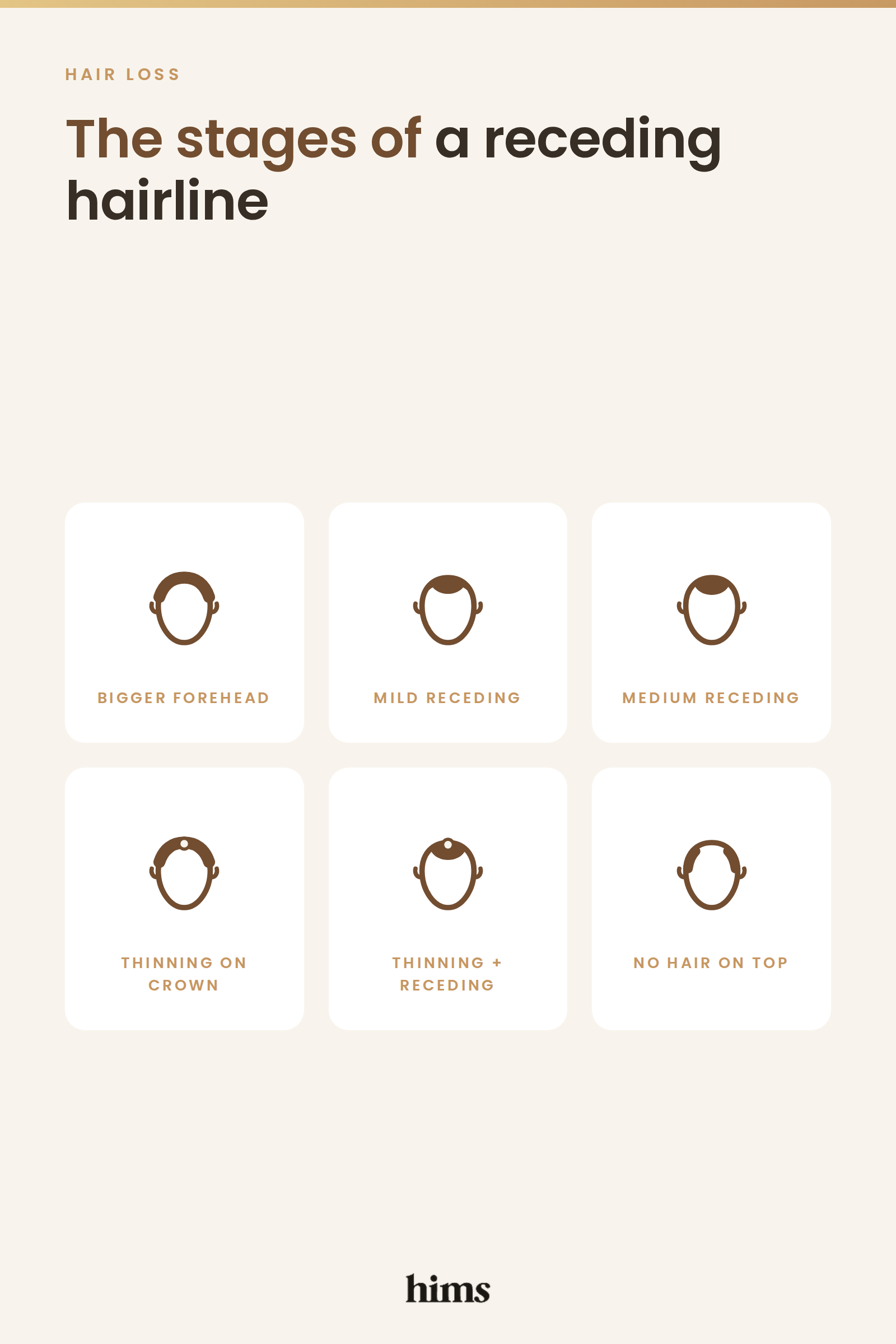 Diagram showing the stages of a receding hairline, from a bigger forehead and mild receding through to thinning on the crown and no hair on top