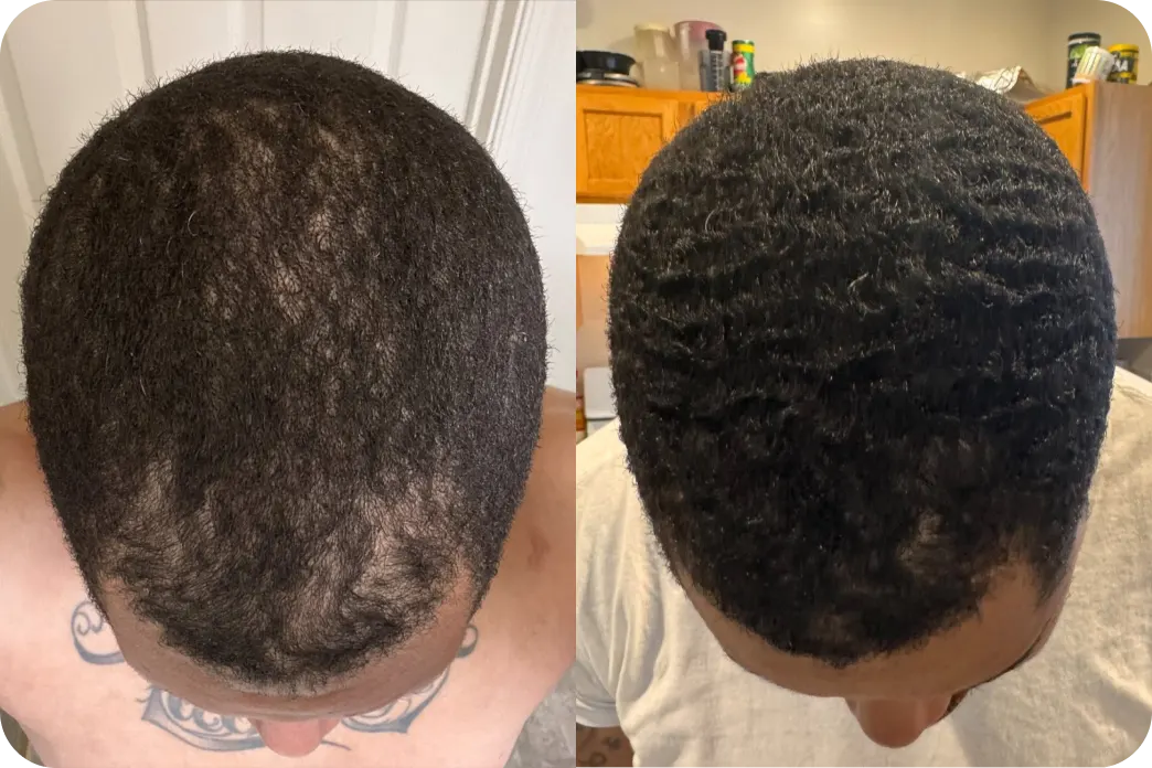 Before and after image of a man using Hims hair loss treatment plan