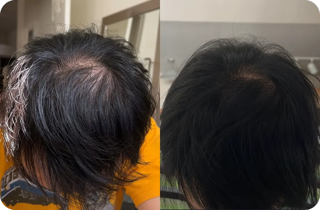 Before and after image of a man using Hims hair loss treatment plan