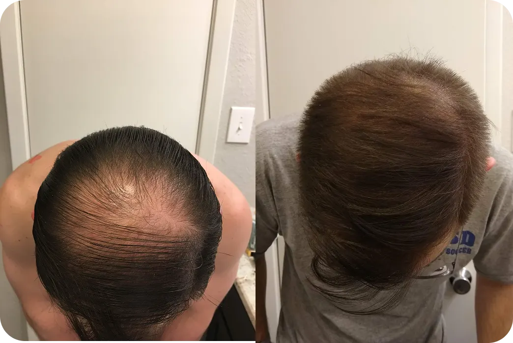 Before and after image of a man using Hims hair loss treatment plan