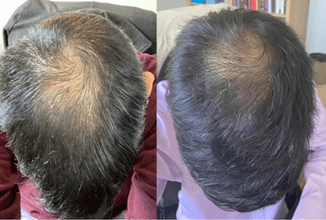 Before and after image of a man using hair loss treatment program by Hims