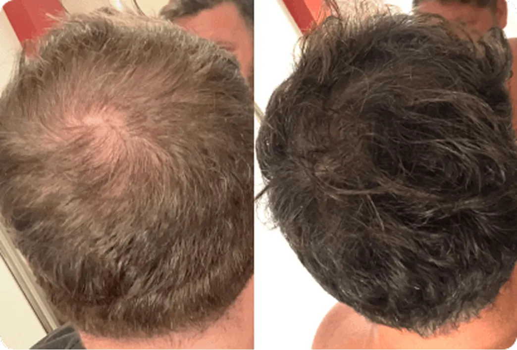 Before and after image of a man using hair loss treatment program by Hims