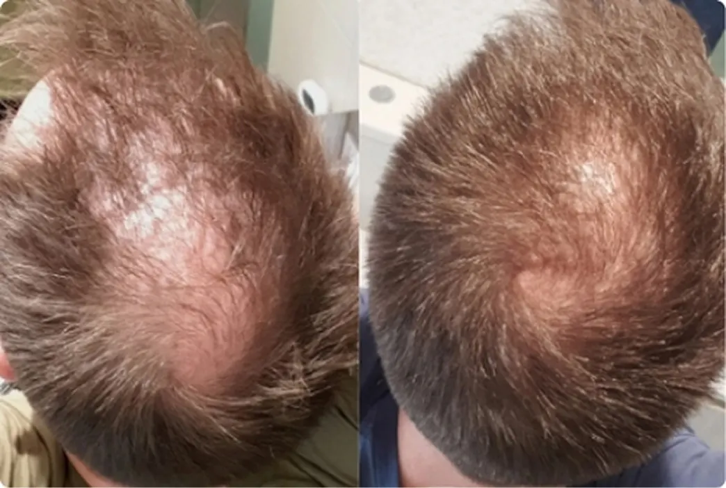 Before and after image of a man using a hair loss treatment plan by Hims
