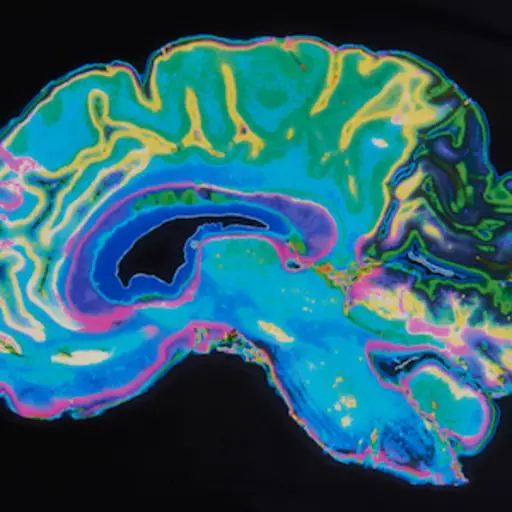 MRI brain scan image