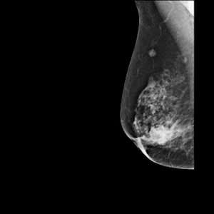 显示乳腺癌的数字乳房x光片。
