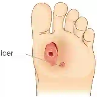 foot ulcers diagram