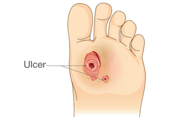 足溃疡图