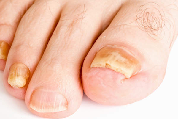 由真菌引起的脚趾甲发黄