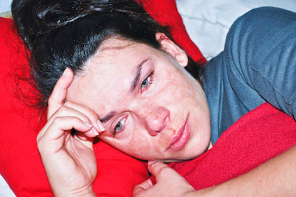 黄褐斑在怀孕。