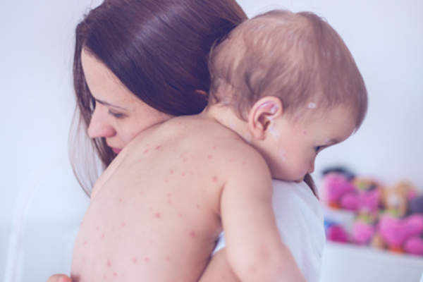 母亲抱着患水痘的孩子。