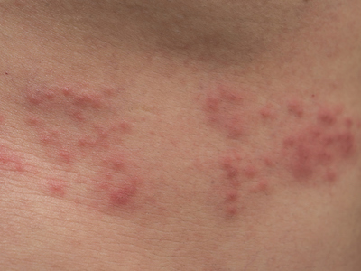 What happens if you get the shingles vaccine twice
