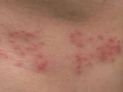 带状疱疹长在人的背上。