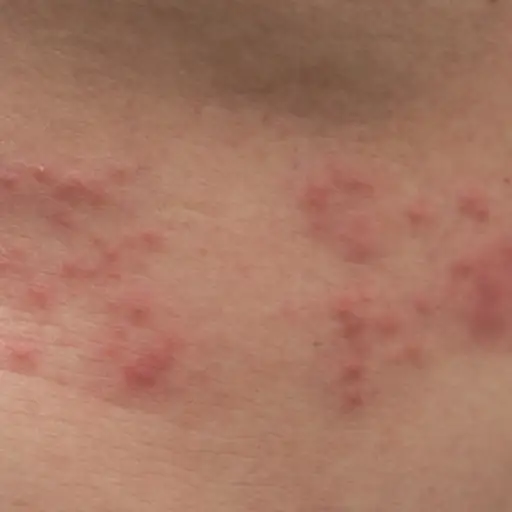 带状疱疹长在人的背上。